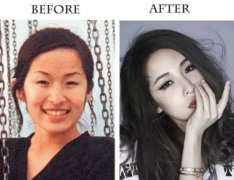 割了双眼皮能变多美？什么样的双眼皮适合自己