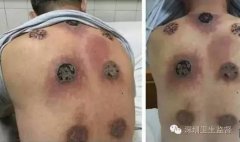 大爷按摩店拔火罐后背烧出七个洞！卫监揭开养