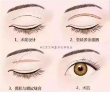 北京双眼皮手术选择埋线or切开？纪柳院长