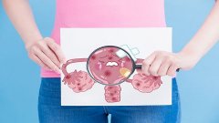 女性不孕大敌——子宫内膜异位